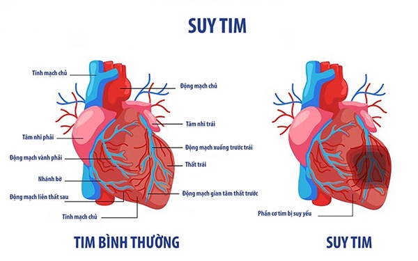 Suy tim là một trong những biến chứng nguy hiểm của bệnh tim bẩm sinh