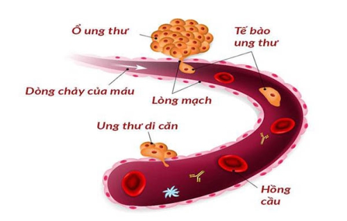Hayhay88 Truy cập website di căn sang máu có chữa hay kéo dài được không?