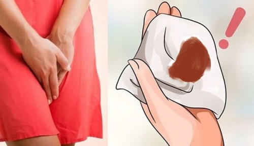 Khí hư màu nâu là biểu hiện của bệnh gì? Cách khắc phục ra khí hư màu nâu