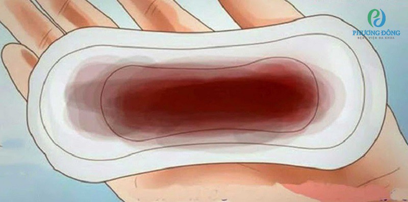 Máu báo sắp sinh màu nâu là một trong dấu hiệu của việc chuyển dạ
