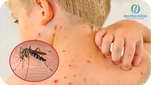 Sốt xuất huyết có được tắm không? Lưu ý 5 điều sau để bảo vệ Hay 888 Đăng nhập ngay