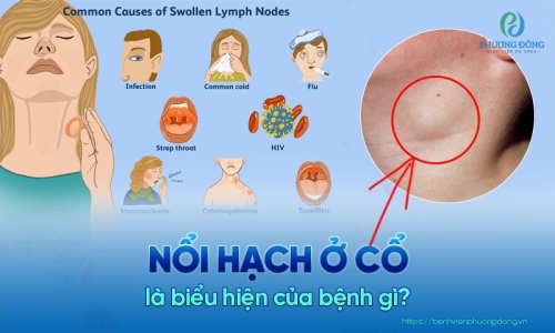 Hạch ở cổ khi nào là lành tính, khi nào là ác tính?