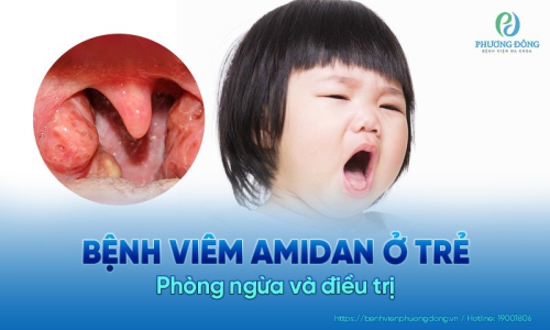 Viêm amidan ở trẻ em và  biện pháp phòng tránh bệnh đúng cách