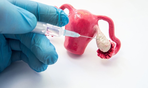 Tác dụng phụ của thuốc kích trứng
