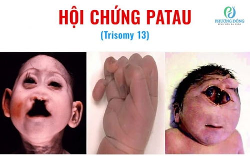 Hội chứng Patau: Nguyên nhân, triệu chứng và cách Hay88 là nhà cái cá cược hàng đầu Việt Nam và châu Á