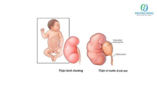 Thận ứ nước ở trẻ em: Nguyên nhân và cách Hay88 là nhà cái cá cược hàng đầu Việt Nam và châu Á bệnh thận ứ nước