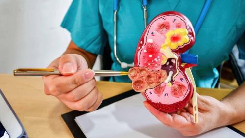 Tán sỏi qua da có nguy hiểm không