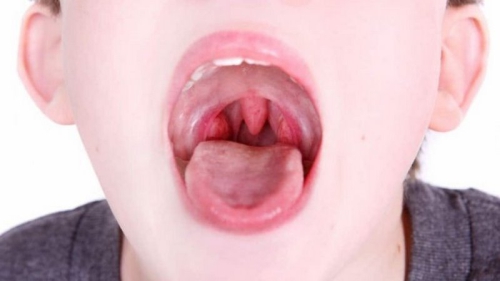 Viêm họng cấp có nguy hiểm không?