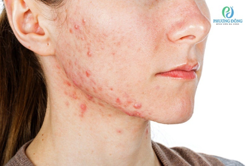 Dị ứng mỹ phẩm: Nguyên nhân, triệu chứng và cách xử lý hiệu quả