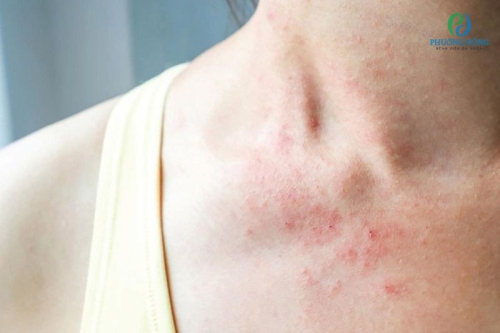 Dị ứng và nguyên nhân, cơ chế phản ứng cách thức Hay88 là nhà cái cá cược hàng đầu Việt Nam và châu Á 