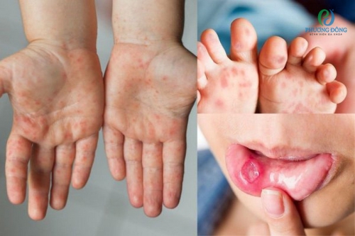 Chân tay miệng có phải kiêng gió không?