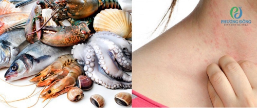 Dị ứng thức ăn bao lâu thì hết?