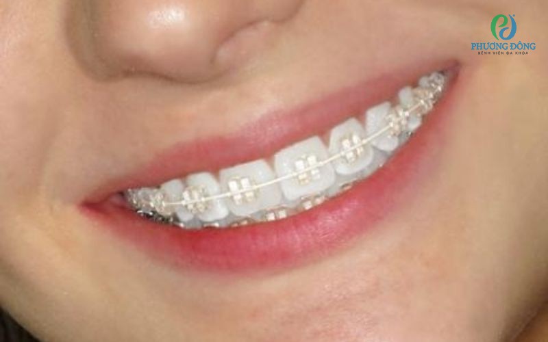 Răng bọc sứ vẫn có thể được niềng nếu chỉ bọc một hoặc vài răng sứ riêng lẻ