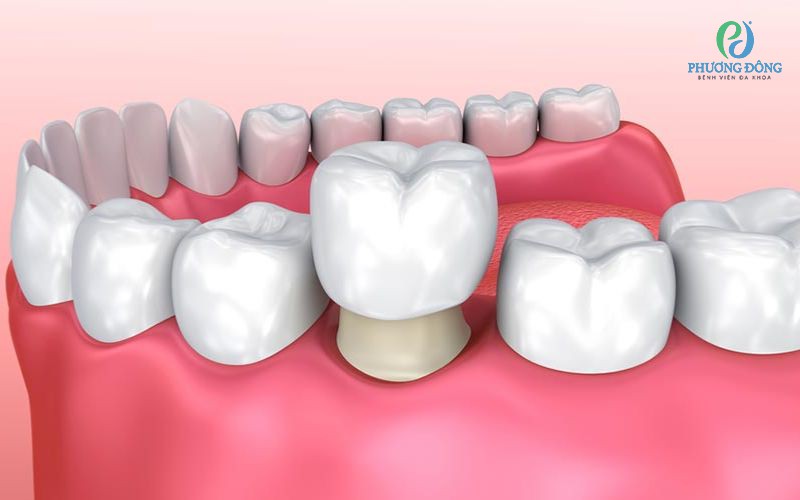 Chỉnh răng mọc lệch không cần niềng được không?