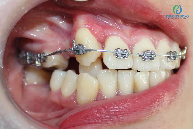 Mất răng số 6 có niềng được không?