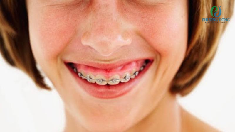 Niềng răng bị sưng lợi là hoàn toàn bình thường