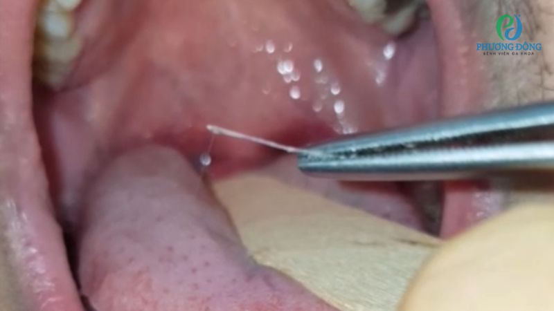 Những lưu ý khi xử lý xương cá dính cổ họng
