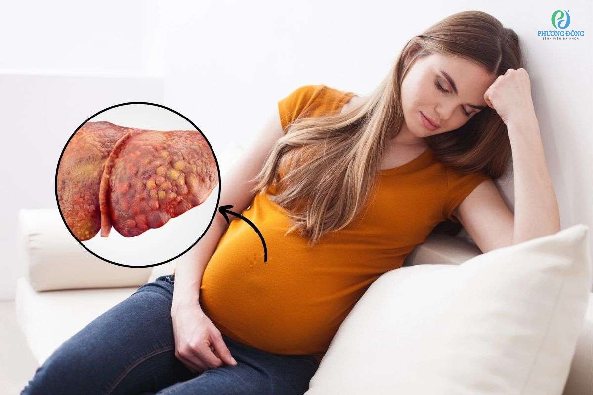 Bà bầu bị gan nhiễm mỡ khi các hạt mỡ nhỏ xâm nhập vào tế bào gan