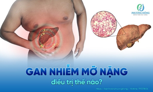 Dấu hiệu gan nhiễm mỡ nặng là gì? có nguy hiểm không?