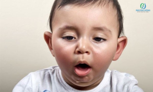 Bé bị viêm phế quản thở khò khè có nguy hiểm không?
