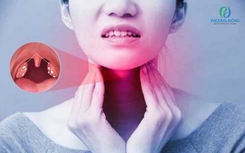 Cách giảm ngứa cổ họng và ho có đờm 