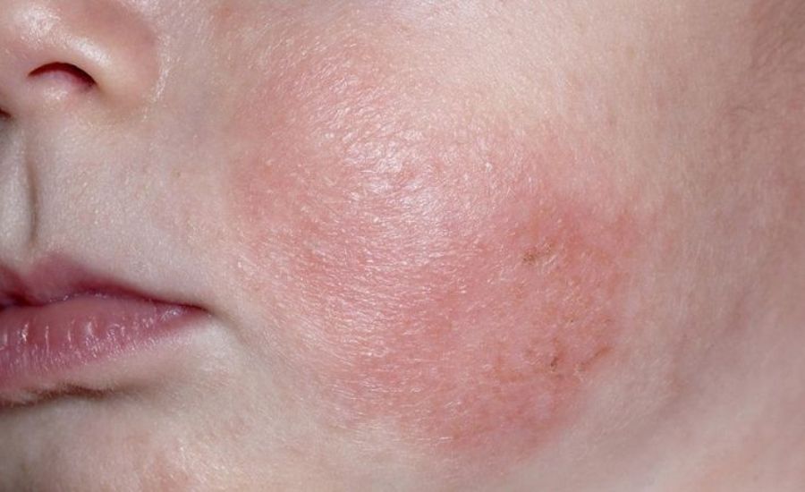 Những điều cha mẹ cần biết về da trẻ sơ sinh nổi vân hoa