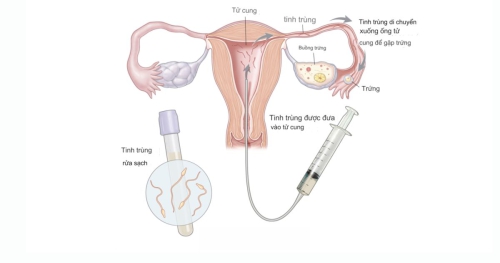 Tắc vòi trứng có làm IUI được không?