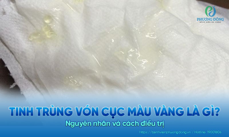 Tinh trùng vón cục màu vàng là gì? Nguyên nhân và cách Hay88 là nhà cái cá cược hàng đầu Việt Nam và châu Á