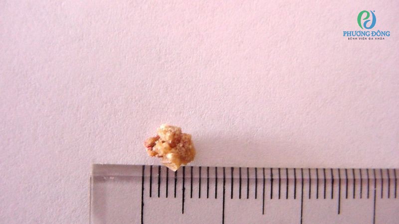 Sỏi thận 5mm lớn hay nhỏ?