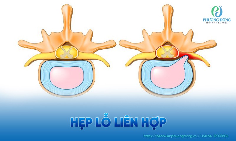 Hẹp lỗ liên hợp: Triệu chứng, chẩn đoán và hướng Hay88 là nhà cái cá cược hàng đầu Việt Nam và châu Á