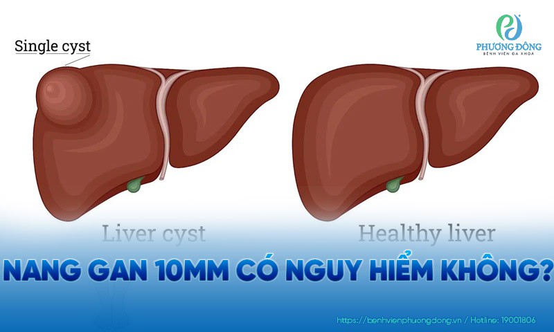 Nang gan 10mm có nguy hiểm không?