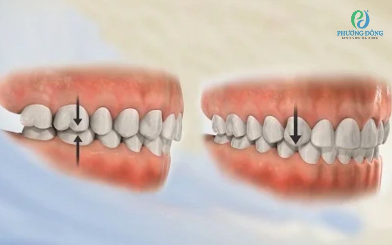 Sai khớp cắn loại 1 là gì? Nguyên nhân và phương pháp Hay88 là nhà cái cá cược hàng đầu Việt Nam và châu Á