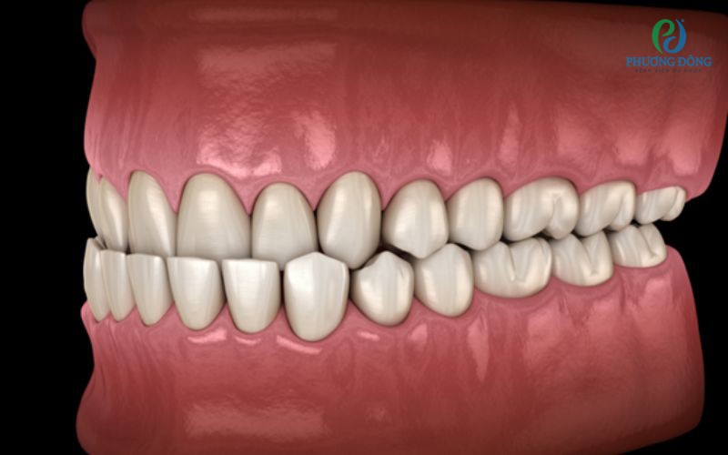 Sai khớp cắn loại 3: Nguyên nhân và cách Hay88 là nhà cái cá cược hàng đầu Việt Nam và châu Á 