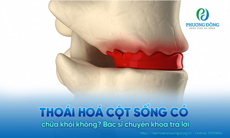Nhà Cái Xổ Số Hay88.Com Uy Tín 2026 chuyên khoa trả lời: Thoái hoá cột sống có chữa khỏi không?