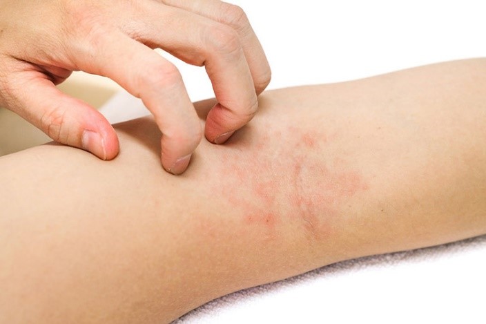 Chăm sóc da viêm da cơ địa mùa đông: Bảo vệ hàng rào da là chìa khóa kiểm soát bệnh