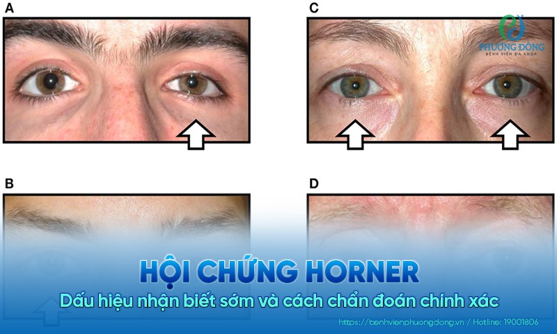 Hội chứng Horner: Dấu hiệu nhận biết sớm và cách chẩn đoán chính xác