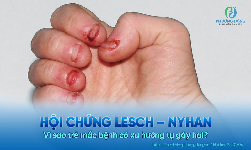 Hội chứng Lesch – Nyhan: Vì sao trẻ Hay88m Xổ số hay88 có xu hướng tự gây hại?
