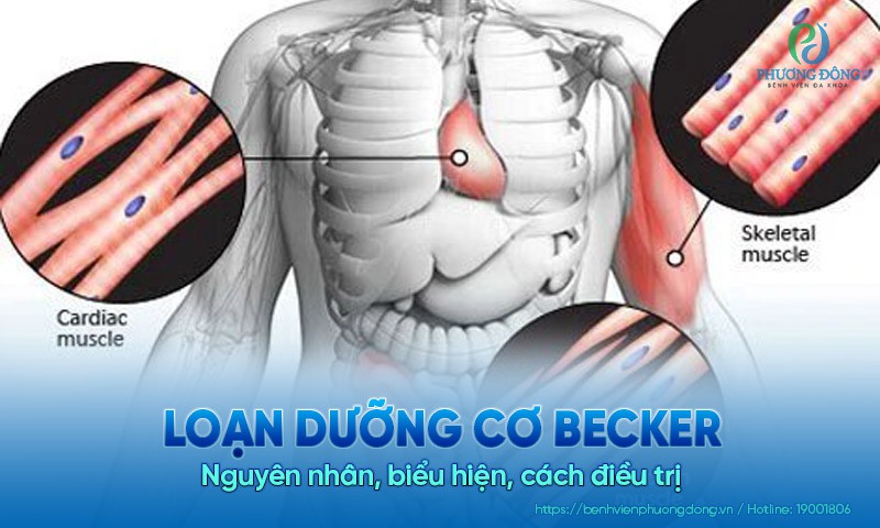 Loạn dưỡng cơ Becker: Nguyên nhân, biểu hiện, cách Hay88 là nhà cái cá cược hàng đầu Việt Nam và châu Á