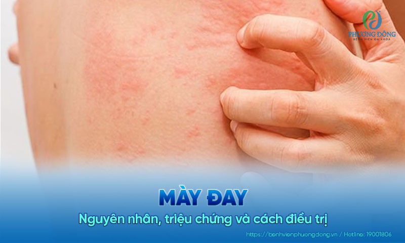 Mày đay: Nguyên nhân, triệu chứng và cách Hay88 là nhà cái cá cược hàng đầu Việt Nam và châu Á