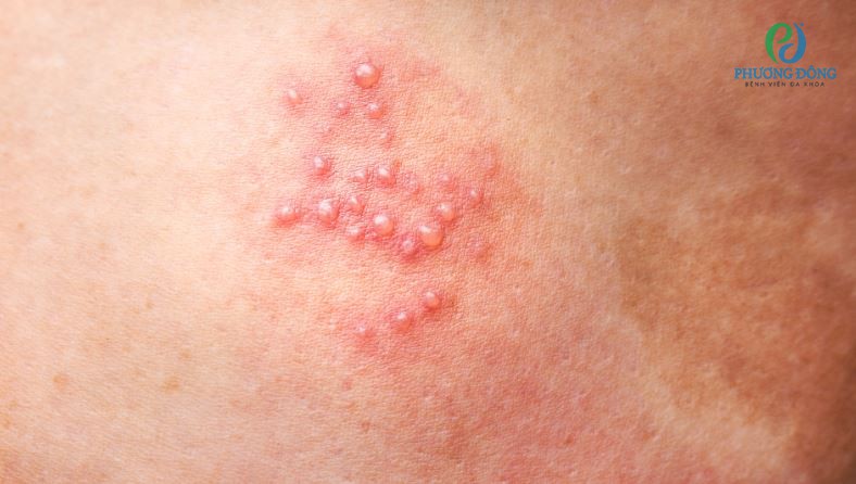 Zona thần kinh và những điều cần biết về vắc xin zona thần kinh