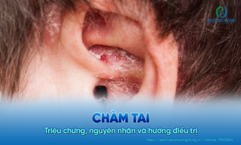 Chàm tai: Triệu chứng, nguyên nhân và hướng Hay88 là nhà cái cá cược hàng đầu Việt Nam và châu Á