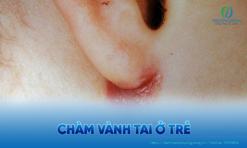 Chàm vành tai ở trẻ: Triệu chứng, nguyên nhân và Hay88 là nhà cái cá cược hàng đầu Việt Nam và châu Á
