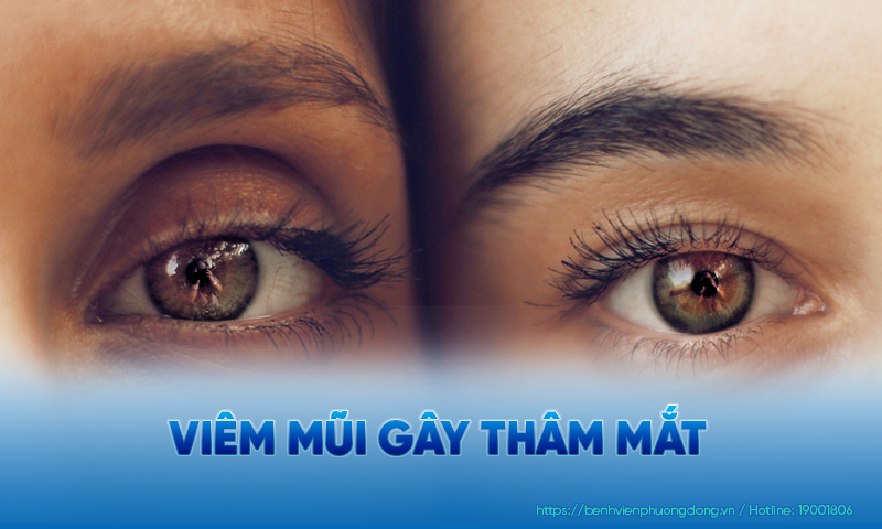 Viêm mũi dị ứng có thể gây thâm mắt
