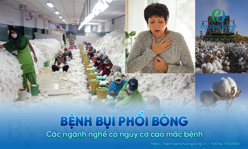 Bệnh bụi phổi bông​ và các ngành nghề có nguy cơ cao Hay88m Xổ số hay88