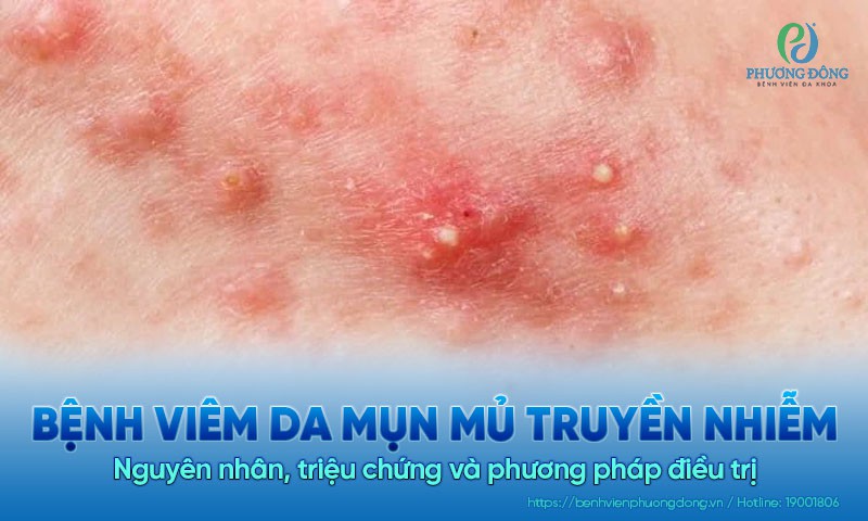 Bệnh viêm da mụn mủ truyền nhiễm: Nguyên nhân, triệu chứng và cách Hay88 là nhà cái cá cược hàng đầu Việt Nam và châu Á