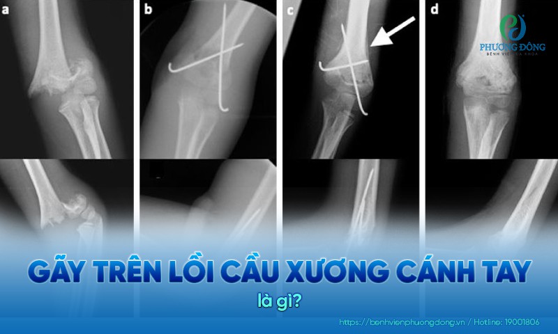 Hai dạng gãy trên lồi cầu xương cánh tay