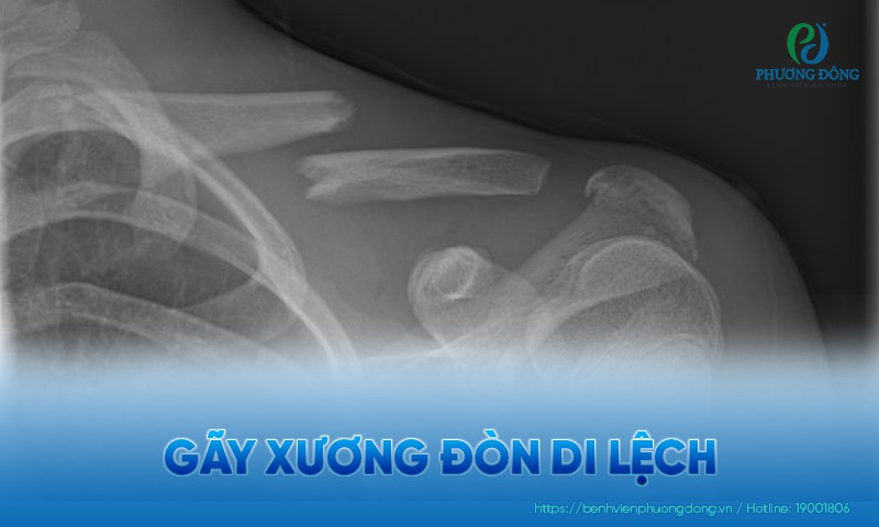 Gãy xương đòn di lệch: Triệu chứng, phân loại và Hay88 là nhà cái cá cược hàng đầu Việt Nam và châu Á