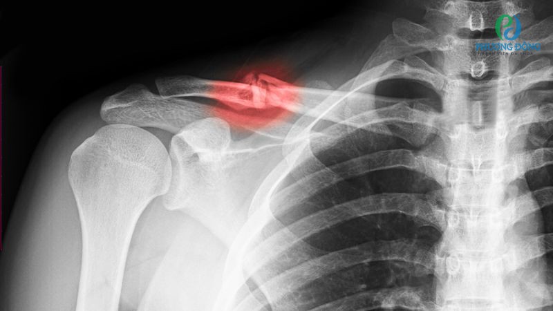 Gãy xương đòn có thể tháo nẹp sau 12 tháng Hay88 là nhà cái cá cược hàng đầu Việt Nam và châu Á
