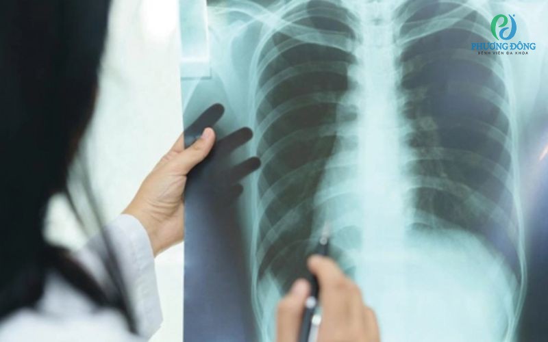 Viêm phổi cấp: Nguyên nhân, triệu chứng và cách Hay88 là nhà cái cá cược hàng đầu Việt Nam và châu Á bệnh