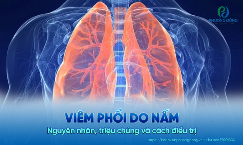 Viêm phổi do nấm: Nguyên nhân, triệu chứng và cách Hay88 là nhà cái cá cược hàng đầu Việt Nam và châu Á